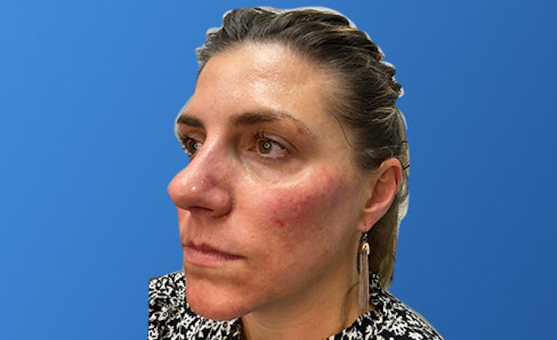 Facial Fillers Before & After Gallery - Patient 155064 - Image 2