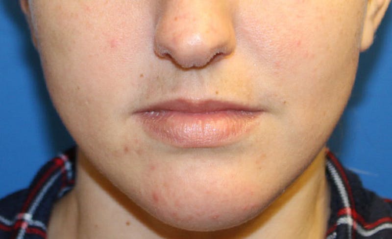 Facial Fillers Before & After Gallery - Patient 225363 - Image 1