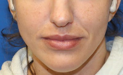 Facial Fillers Before & After Gallery - Patient 225363 - Image 2
