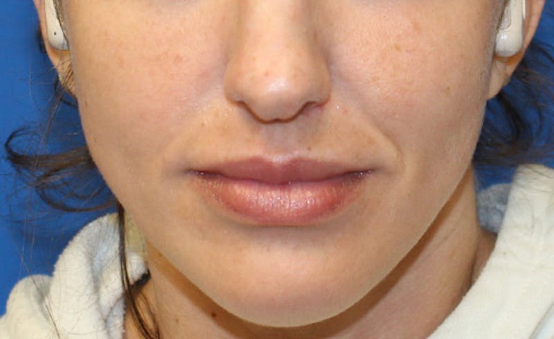 Facial Fillers Before & After Gallery - Patient 225363 - Image 2