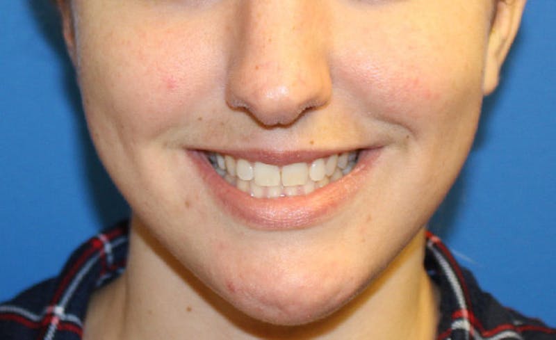 Facial Fillers Before & After Gallery - Patient 225363 - Image 3