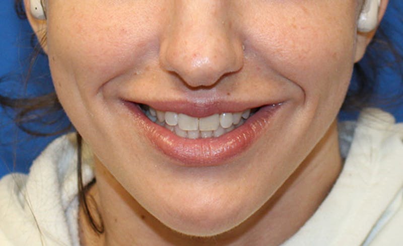 Facial Fillers Before & After Gallery - Patient 225363 - Image 4