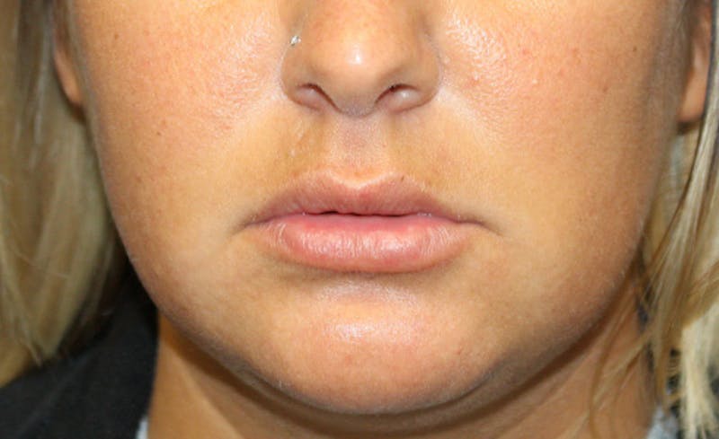 Facial Fillers Before & After Gallery - Patient 794247 - Image 1