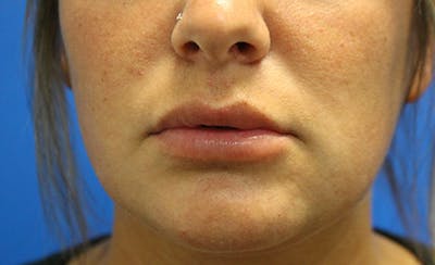 Facial Fillers Before & After Gallery - Patient 794247 - Image 2