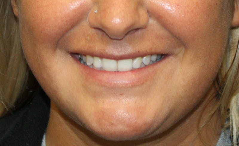 Facial Fillers Before & After Gallery - Patient 794247 - Image 3