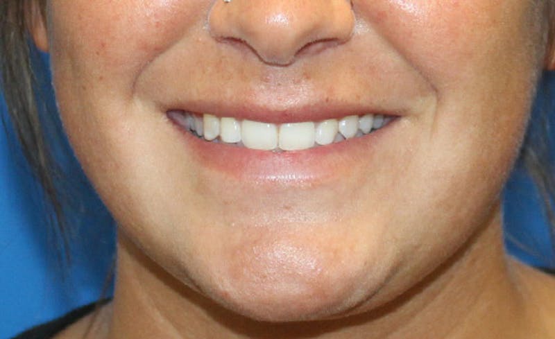 Facial Fillers Before & After Gallery - Patient 794247 - Image 4