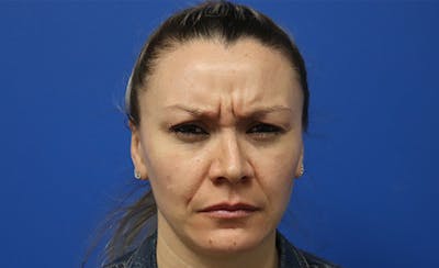 Botox Xeomin Before & After Gallery - Patient 249674 - Image 1