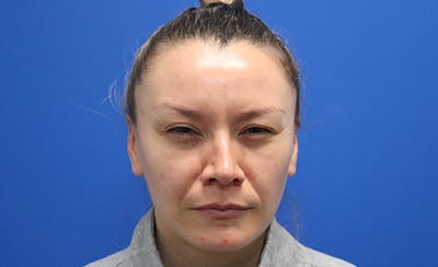 Botox Xeomin Before & After Gallery - Patient 249674 - Image 2
