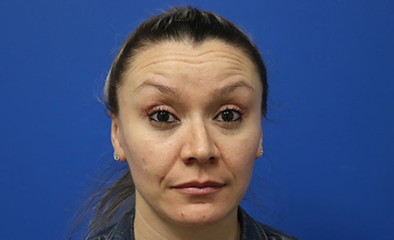 Botox Xeomin Before & After Gallery - Patient 249674 - Image 3