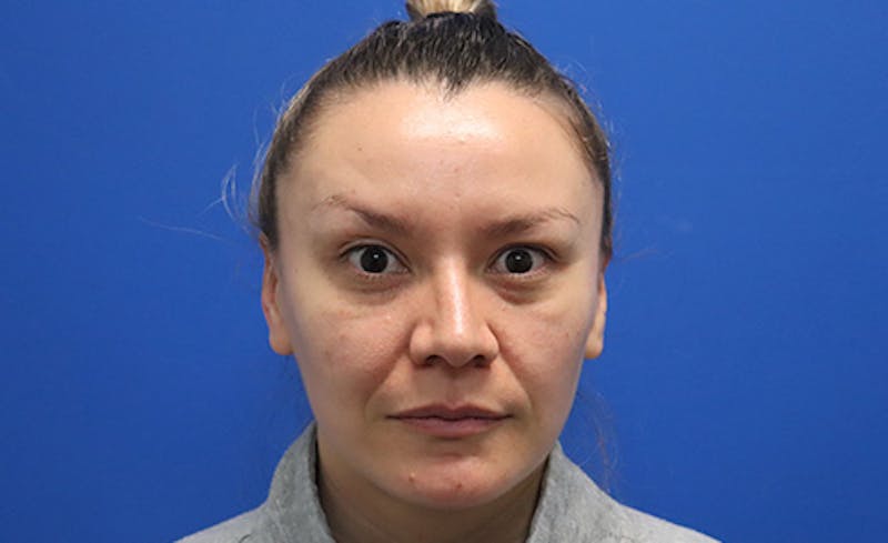 Botox Xeomin Before & After Gallery - Patient 249674 - Image 4