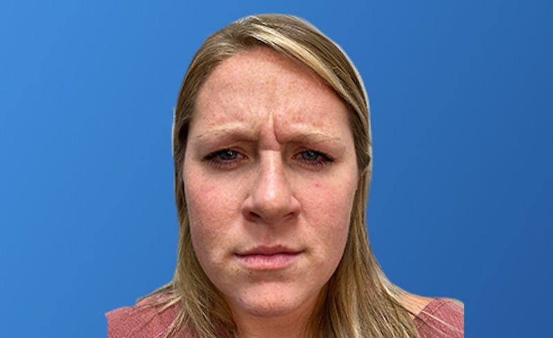 Botox Xeomin Before & After Gallery - Patient 206208 - Image 1