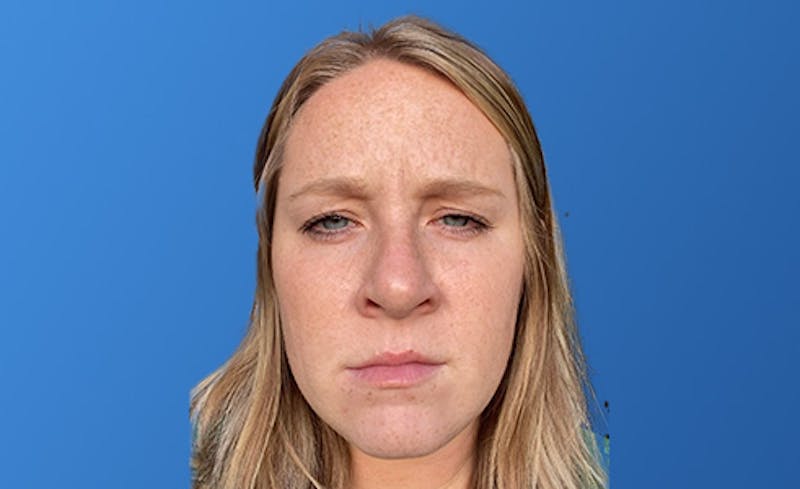 Botox Xeomin Before & After Gallery - Patient 206208 - Image 2