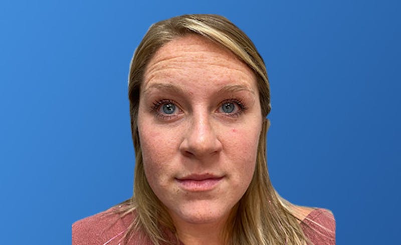 Botox Xeomin Before & After Gallery - Patient 206208 - Image 3