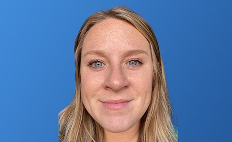 Botox Xeomin Before & After Gallery - Patient 206208 - Image 4