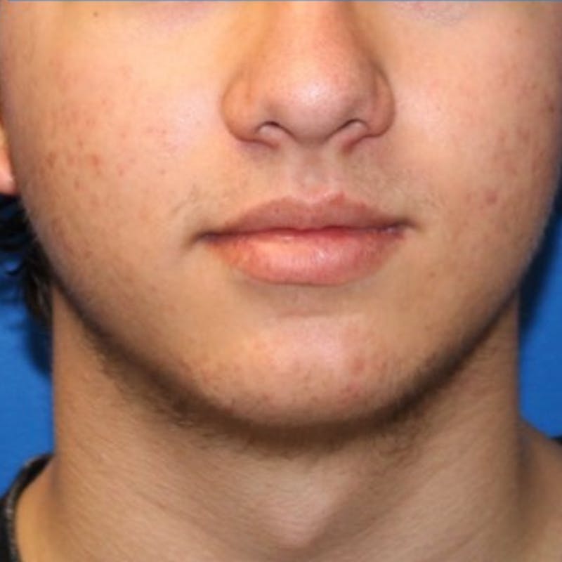 Halo BBL Before & After Gallery - Patient 348599 - Image 2