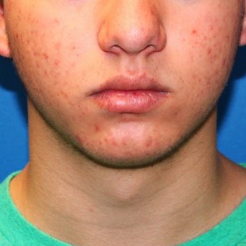 Halo BBL Before & After Gallery - Patient 348599 - Image 1