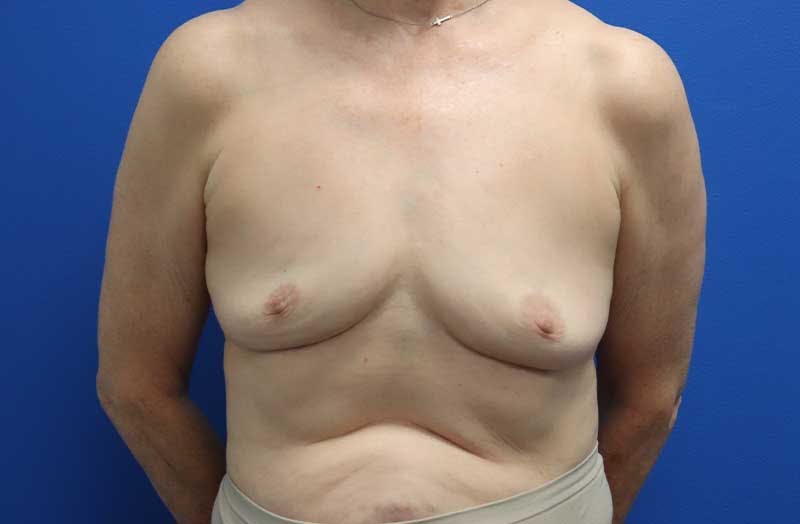 Breast Implant Removal Before & After Gallery - Patient 291695 - Image 2