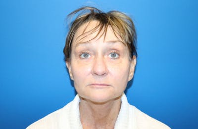 Facelift Before & After Gallery - Patient 272099 - Image 2
