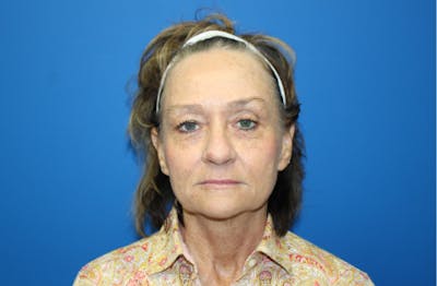 Facelift Before & After Gallery - Patient 272099 - Image 1