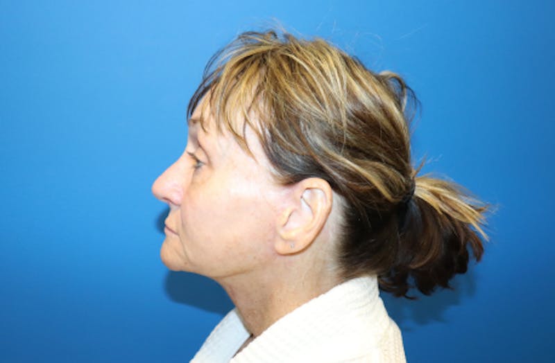Facelift Before & After Gallery - Patient 272099 - Image 6