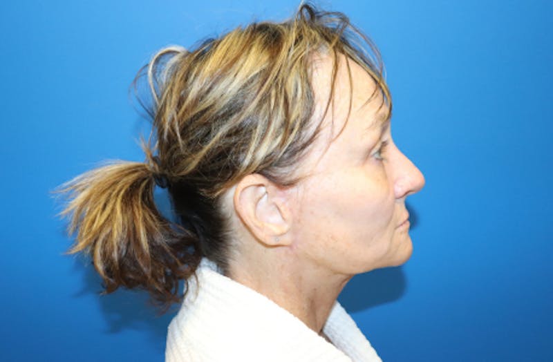 Facelift Before & After Gallery - Patient 272099 - Image 4