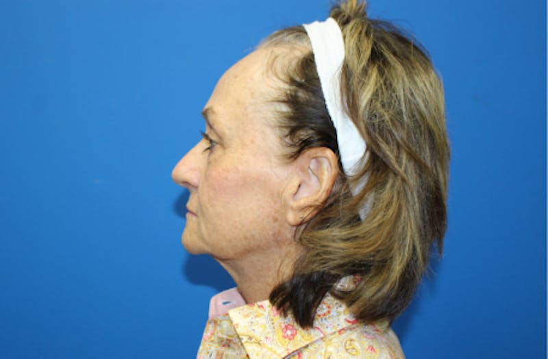 Facelift Before & After Gallery - Patient 272099 - Image 5