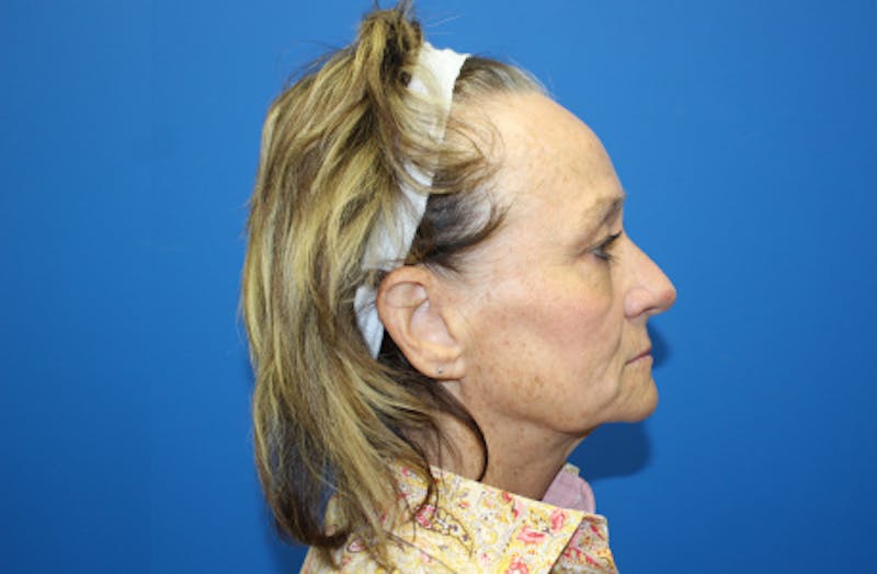 Facelift Before & After Gallery - Patient 272099 - Image 3