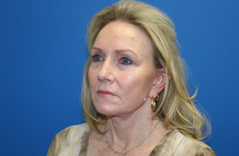 Facelift Before & After Gallery - Patient 116987 - Image 4