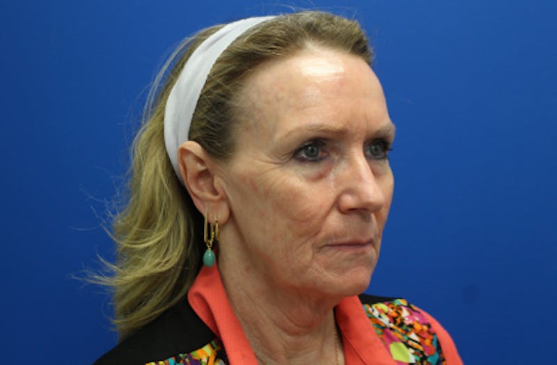 Facelift Before & After Gallery - Patient 116987 - Image 5