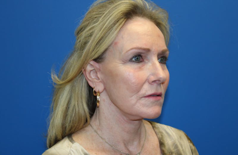 Facelift Before & After Gallery - Patient 116987 - Image 6