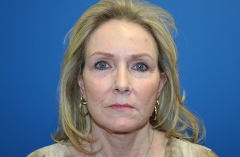 Facelift Before & After Gallery - Patient 116987 - Image 2