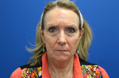 Facelift Before & After Gallery - Patient 116987 - Image 1