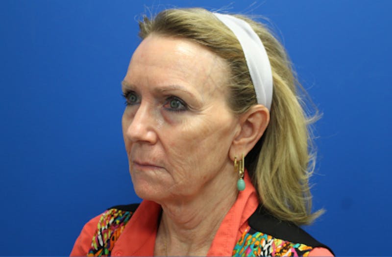 Facelift Before & After Gallery - Patient 116987 - Image 3
