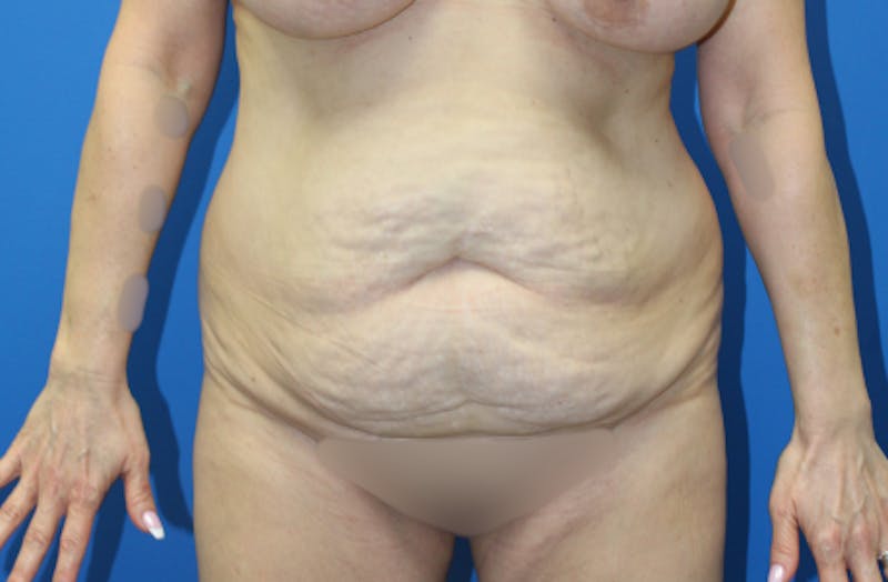 Abdominoplasty Before & After Gallery - Patient 411944 - Image 1