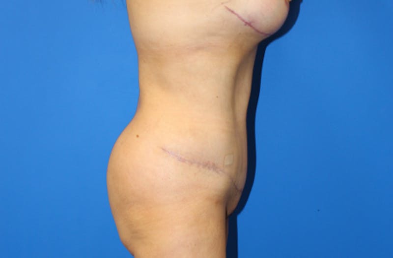 Abdominoplasty Before & After Gallery - Patient 411944 - Image 6