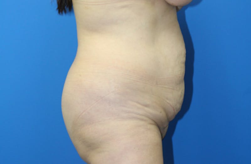 Abdominoplasty Before & After Gallery - Patient 411944 - Image 5