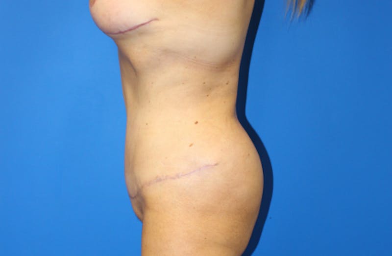 Abdominoplasty Before & After Gallery - Patient 411944 - Image 4