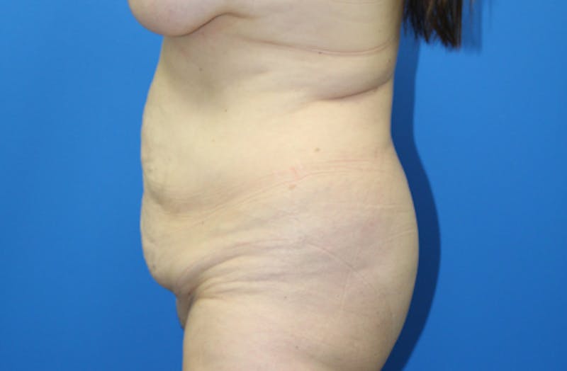 Abdominoplasty Before & After Gallery - Patient 411944 - Image 3