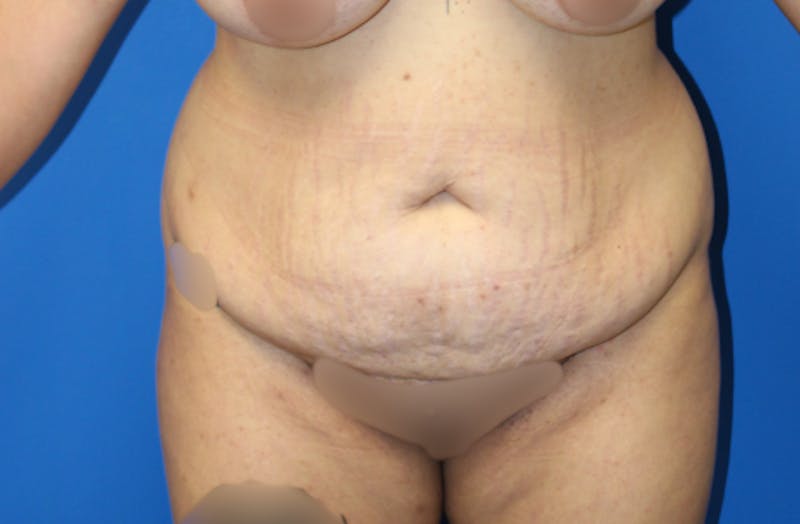Abdominoplasty Before & After Gallery - Patient 157777 - Image 1