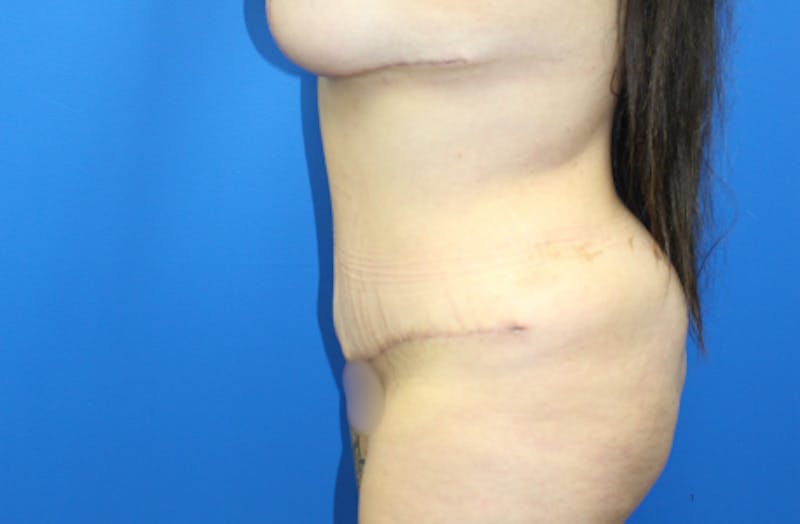 Abdominoplasty Before & After Gallery - Patient 157777 - Image 6
