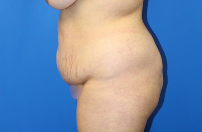 Abdominoplasty Before & After Gallery - Patient 157777 - Image 5