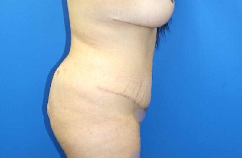 Abdominoplasty Before & After Gallery - Patient 157777 - Image 4