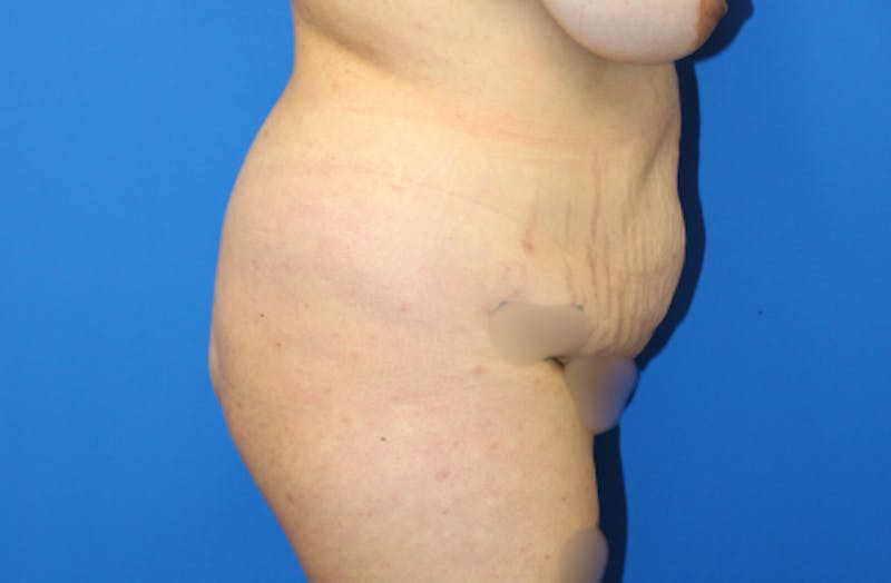 Abdominoplasty Before & After Gallery - Patient 157777 - Image 3