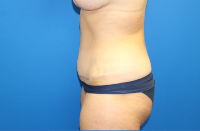 Abdominoplasty Before & After Gallery - Patient 356520 - Image 4