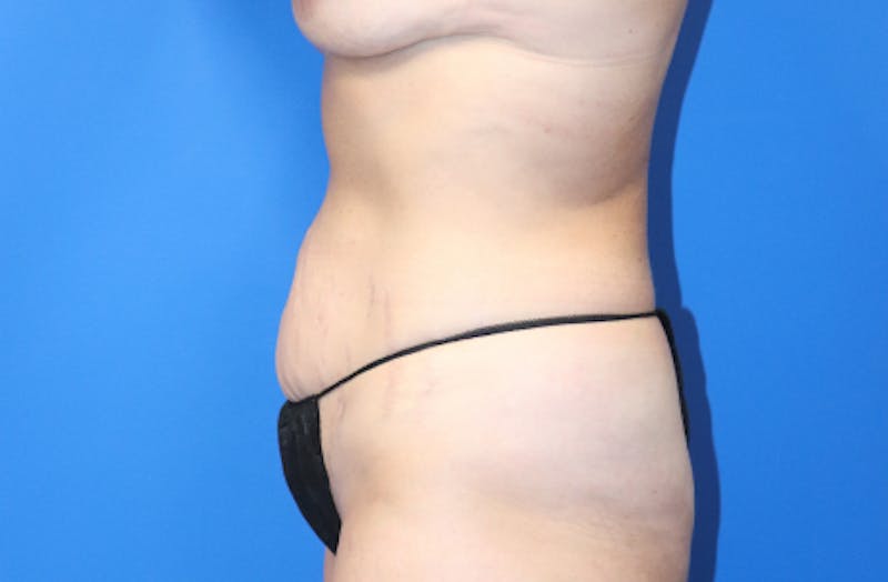 Abdominoplasty Before & After Gallery - Patient 356520 - Image 3