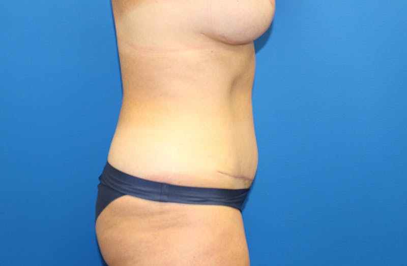 Abdominoplasty Before & After Gallery - Patient 356520 - Image 6
