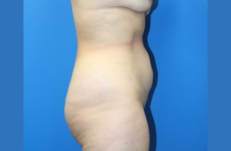 Abdominoplasty Before & After Gallery - Patient 356520 - Image 5