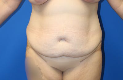 Abdominoplasty Before & After Gallery - Patient 906291 - Image 1