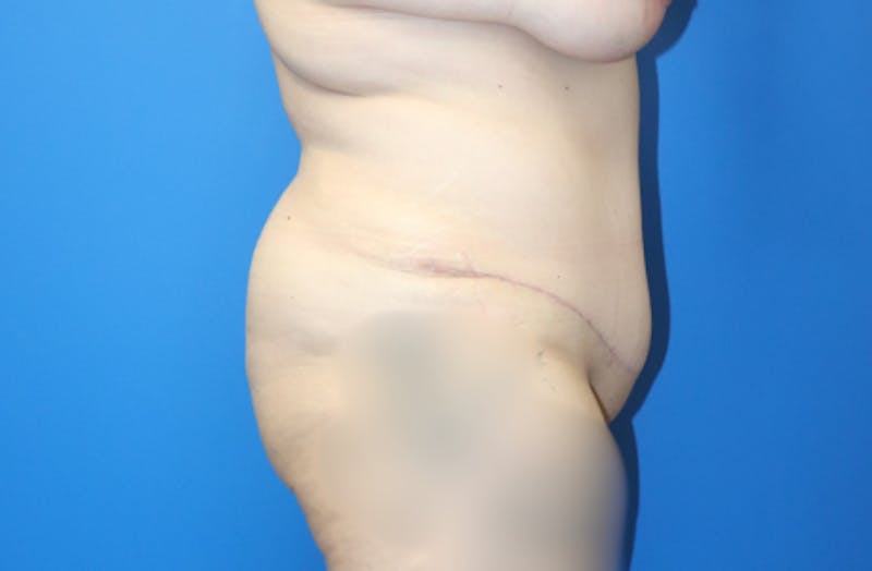 Abdominoplasty Before & After Gallery - Patient 906291 - Image 6