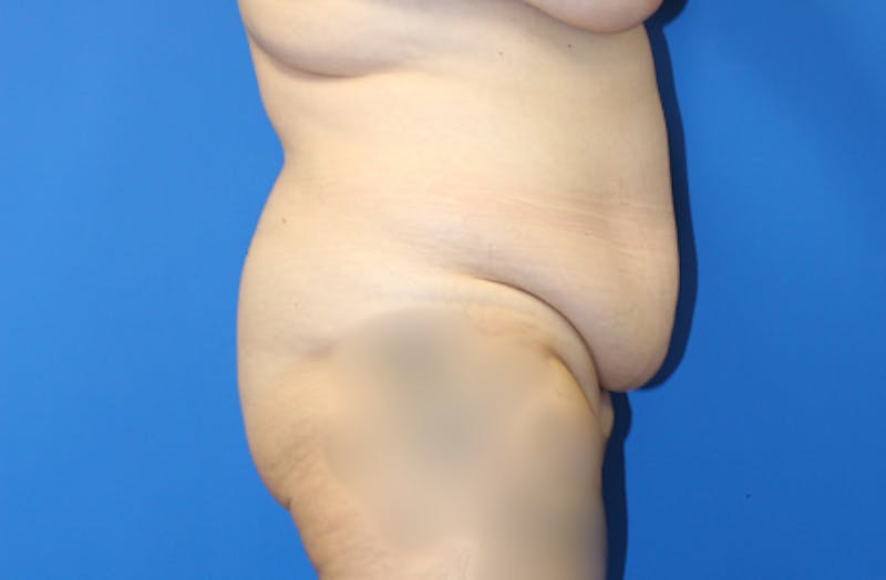 Abdominoplasty Before & After Gallery - Patient 906291 - Image 5